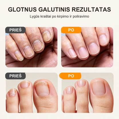 Glotnus nagų priežiūros rezultatas